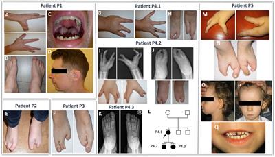 A genotype–phenotype correlation in split-hand/foot malformation type 1: further refinement of the phenotypic subregions within the 7q21.3 locus